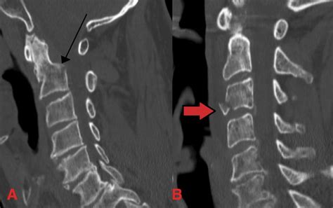 opener Prestigioso montanaro vertebral body fracture treatment cazzo Uomo Esecutore