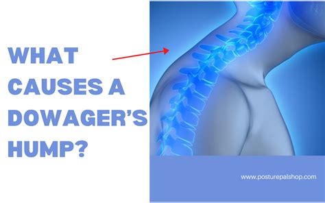 What Causes A Dowager’s Hump? – Posture Pal