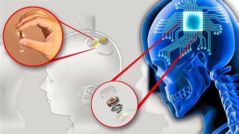 Elon Musk Neuralink Brain Chip - The Digital Tech