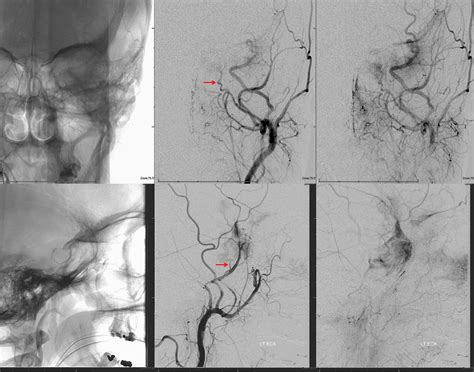 Archives Skull Base Meningioma Embolization MHT Access | neuroangio.org