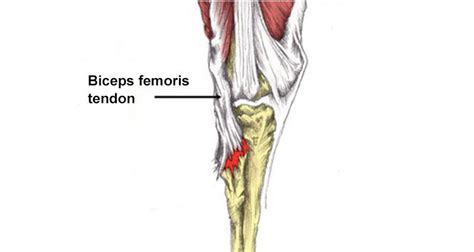 Biceps Femoris Tendon Pain