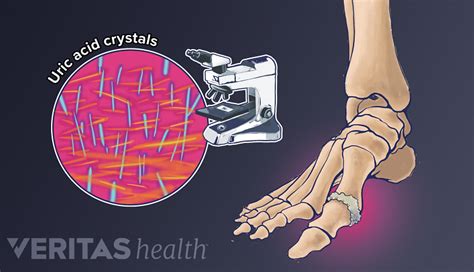 Hyperuricemia - High Uric Acid Levels and Gout | Arthritis-health