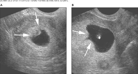 Figure 3 from The chorionic bump: a first-trimester pregnancy sonographic finding associated ...