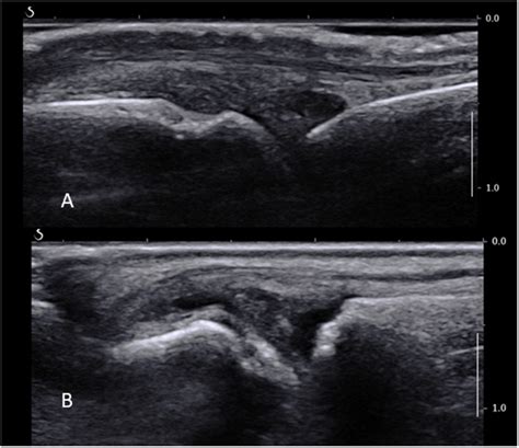 (A) Normal MCP joint on a longitudinal ultrasound view. Note the joint... | Download Scientific ...