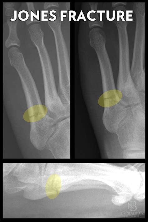 Understanding the Jones Fracture of the Foot