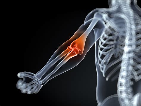 Overview of Inflammatory Arthritis