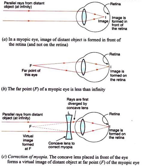 Explain with the help of labelled ray diagram, the defect of vision called myopia and how it is ...