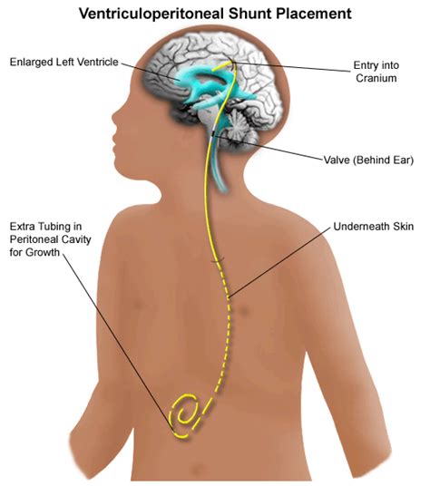 2.1 Children with Nervous System Disorders: Cephalic Disorders — ECI – Module 2: Special Needs ...