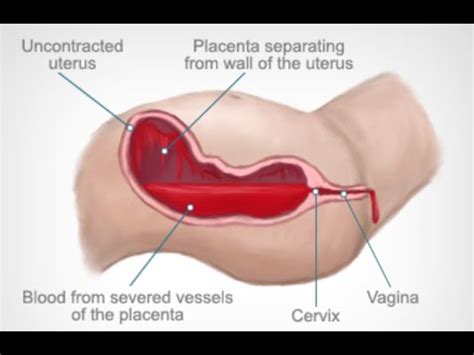 Explain The Warning Signs Of A Boggy Or Soft Uterus - wondermegabest