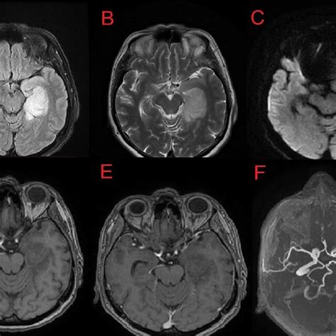 Head MRI showing a lesion in the left temporal lobe of the brain,... | Download Scientific Diagram