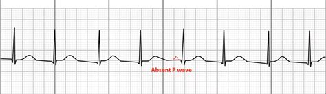 Accelerated Junctional Rhythm Ecg Examples