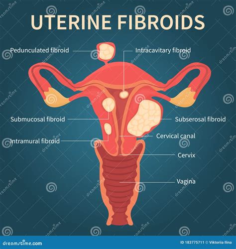 Uterus & Types Of Fibroids Vector Illustration | CartoonDealer.com #35849036