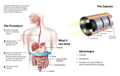 Dr. NIVESH SEEHRA :: Capsule Endoscopy