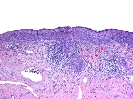 Squamous cell carcinoma of the uterine cervix - Libre Pathology