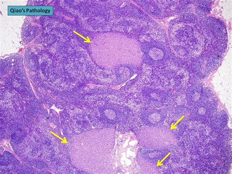 Pathological lymph node - tewsgas