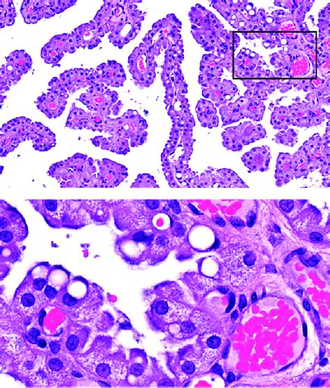 -PEG-related vacuole formation in the choroid plexus (CP) epithelium of ...