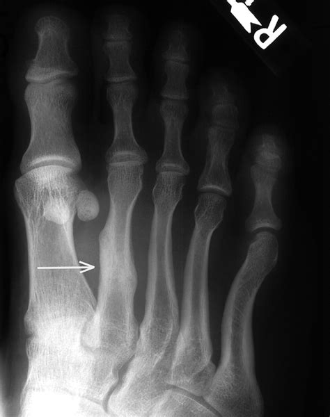 How to treat foot Stress fractures | Our Brisbane podiatrists explain ...