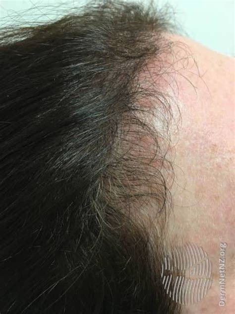 Find out How Fast Your Hair Grows in the Anagen Phase