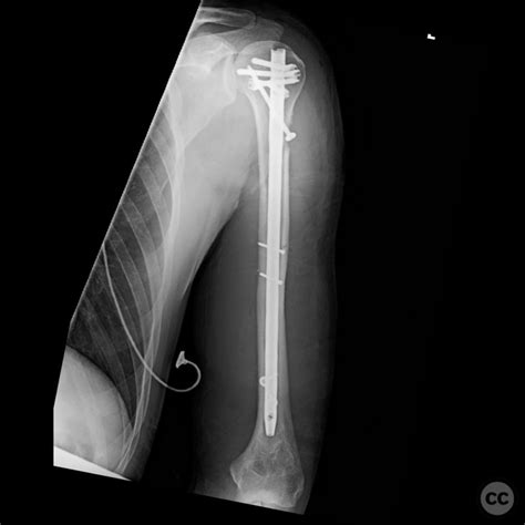 Spiral proximal humerus fracture with long butterfly fragment - IM nail plus interfragmentary ...