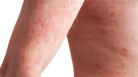 Inverse Psoriasis: Pictures, Causes, and Treatments