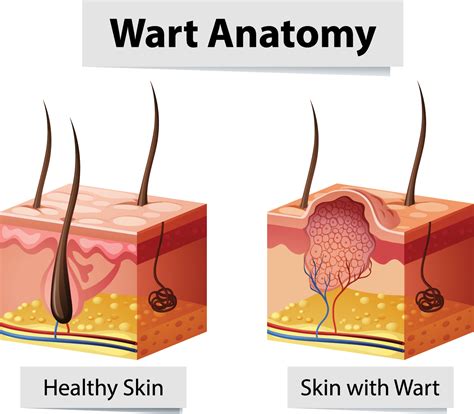 Wart Removal in Nashville Tennessee - Curcio Dermatology