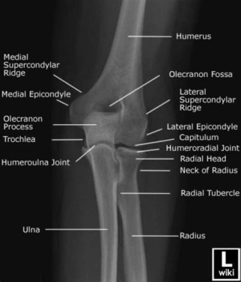 Olecranon Fossa X Ray