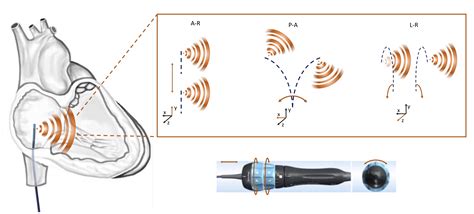 The contribution of intracardiac echocardiography in catheter ablation of ventricular arrhythmias