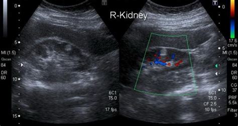 Renal angiomyolipomas (AML) are type of benign renal neoplasm and are ...