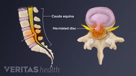 Spinal Cord and Cauda Equina of the Lumbar Spine | Spine-health