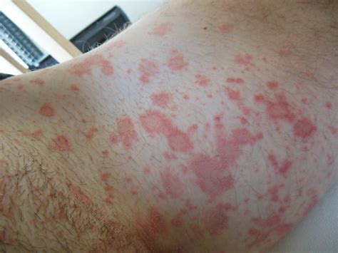 What Does A Gradually Spreading Rash On The Groin Indicate?