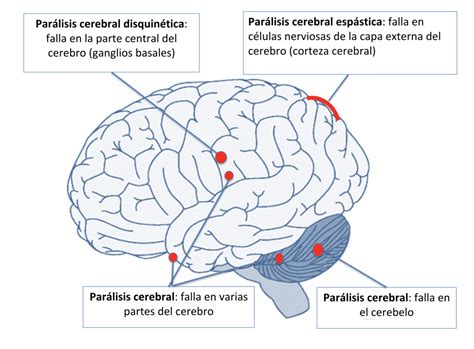 ¿Qué es la Parálisis Cerebral? ¡Porque Puedes! Blog Fisioterapia México