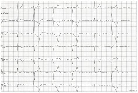 Float Nurse: Atrial Fibrillation with Ventricular Escape Beats