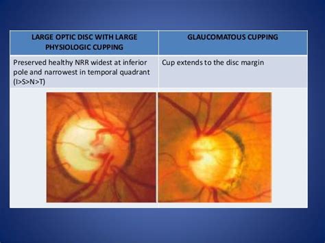 Optic disc evaluation