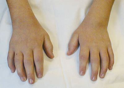 Juvenile Arthritis In Children Symptoms And Treatment | Health And Beauty