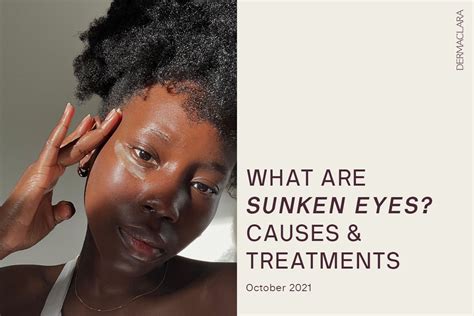 What Are Sunken Eyes? Causes and Treatments