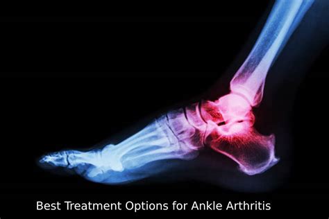 Best Treatment Options for Ankle Arthritis