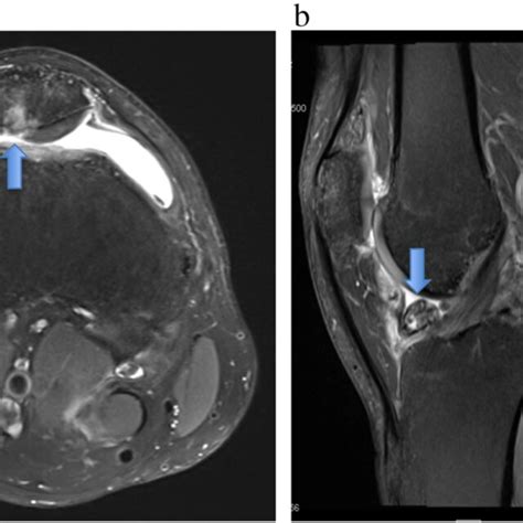 Typical MRI appearance of subchondral osteoarthritis-associated BML in... | Download Scientific ...