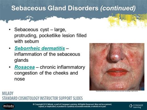 Sebaceous gland disorders | Seborrheic dermatitis, Sebaceous gland ...