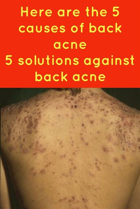 What are the 5 causes of back acne? How to treat back acne at home ? – Sportcom.us | Acne ...