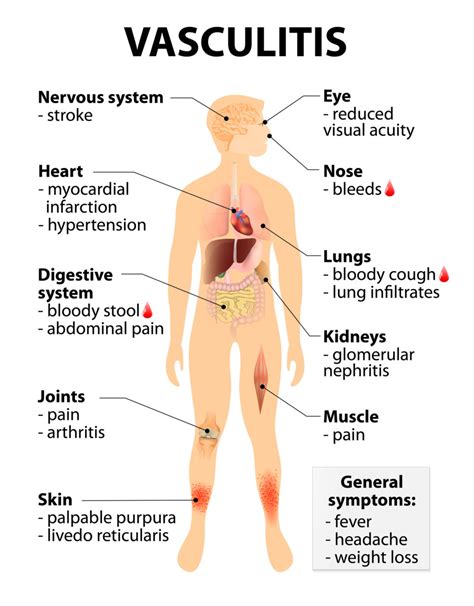 Vasculitis And Behcet’s Disease – AZIV Infusion Therapy Center