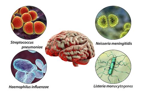 Causes Of Bacterial Meningitis Photograph by Kateryna Kon/science Photo Library - Fine Art America