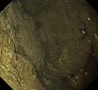 Active bleeding caused by portal hypertensive gastropathy - Gastrointestinal Endoscopy