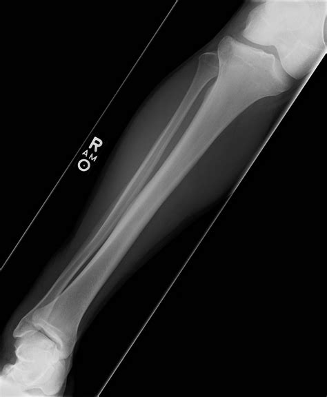 Orthopedic Injuries