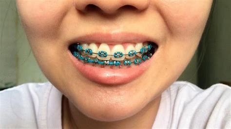 Pin by 𝕴𝖘𝖆𝖍.🌊 on aparelho tumblr | Braces colors, Orthodontics braces ...