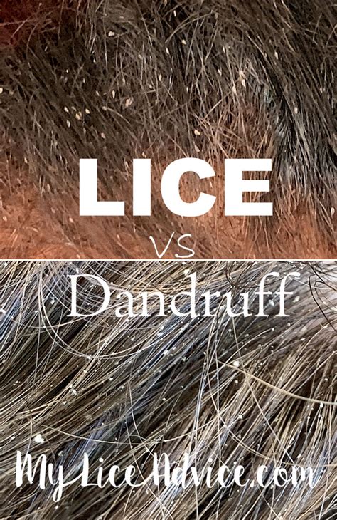 Identify - My Lice Advice