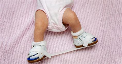 The Ponseti Method for Clubfoot Correction | HSS Pediatrics☣️ Mergulhe ...