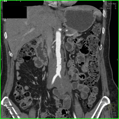 Retroperitoneal Fibrosis Causes Symptoms Treatment