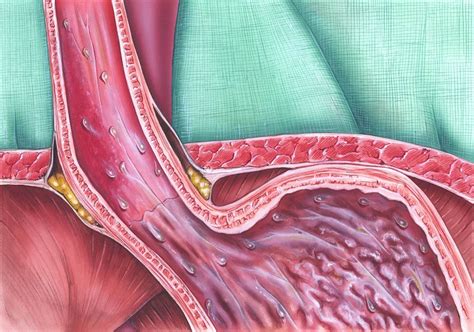 BILE REFLUX: SYMPTOMS, TREATMENT AND DIET - Equality Mag