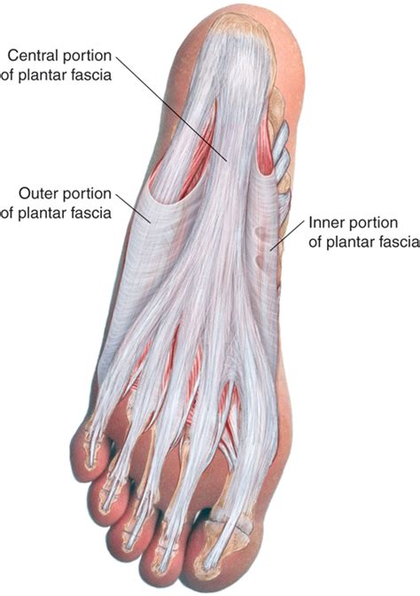 Plantar Fasciitis | 5MinuteConsult