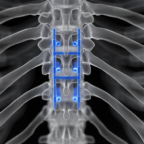 Benefits Of Spinal Fusion | New Jersey | Comprehensive Spine Care